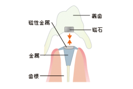 磁性アタッチメント義歯